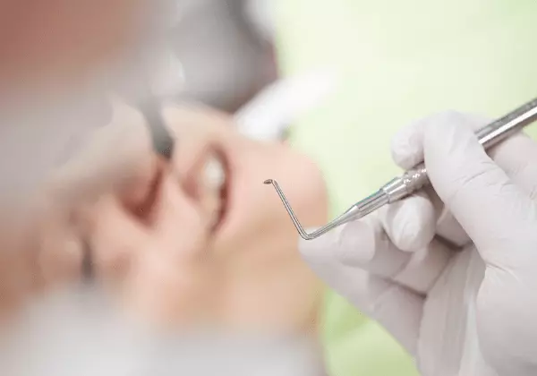 Eine Karies wird beim Zahnarzt mit einem Instrument behandelt