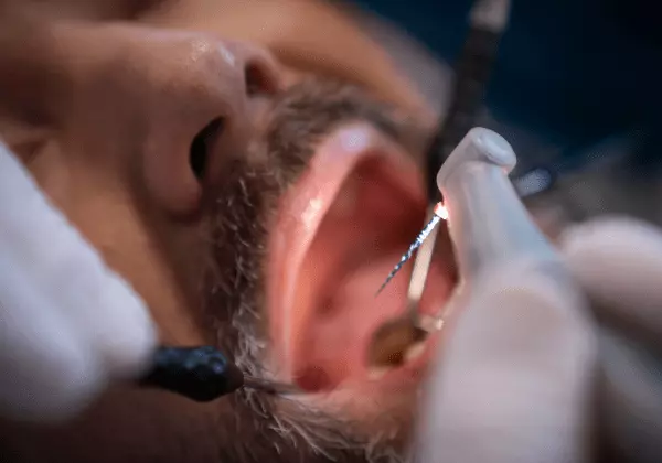 Blick in den Mund eines Patienten bei der Kariesbehandlung