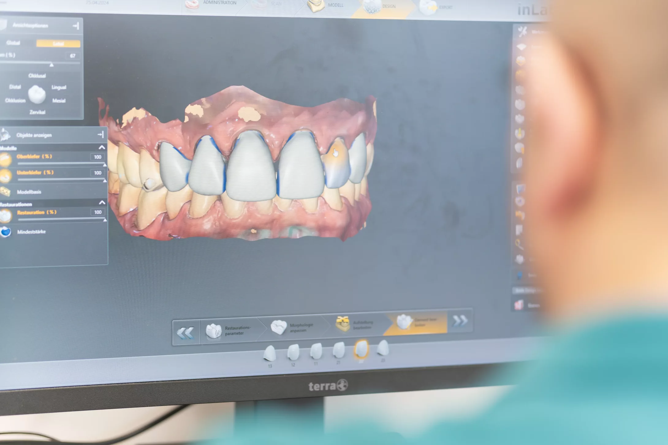 Digitale Zahnmedizin in Esslingen Digitale Aufnahme von Zähnen und Zahnfleisch